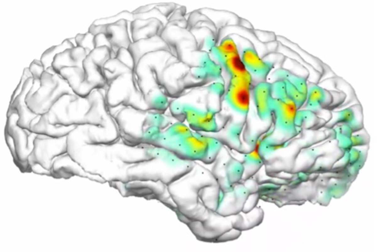 3D-Rekonstruktion eines menschlichen Gehirns mit projizierter epileptischer Aktivität. In Grau ist der Kortex zu sehen, der aus einem komplexen Geflecht von Hügeln und Tälern besteht. Ein Anfall breitet sich in der rechten Frontalregion aus. © zvg
