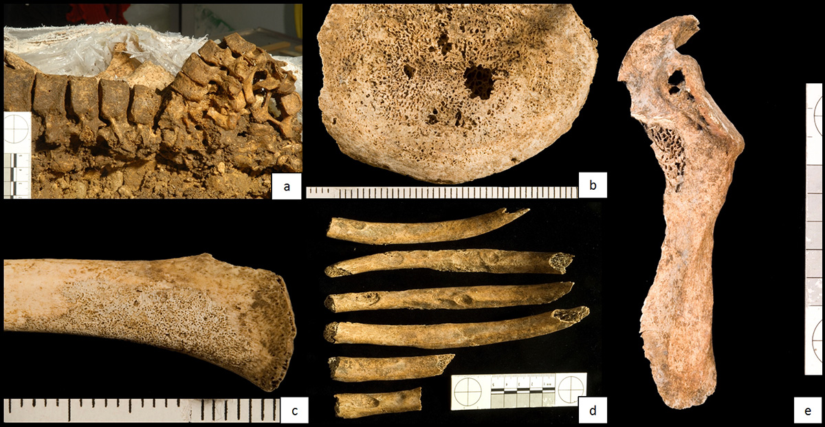 Anzeichen von Knochentuberkulose: a: Zerstörung mehrerer Wirbelkörper und Buckelbildung; b: Knochenauflösung an einem Wirbel; c: Knochenneubildung an einer Rippe; d: Knochenauflösende Läsionen an mehreren Rippen; e: Knochenauflösender Defekt am Schulterblatt.