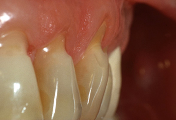 Überempfindliche Zähne