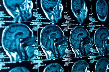 Foto mit verschiedenen Röntgenbildern des Gehirns
