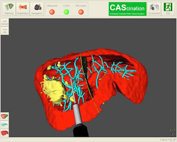 Bild aus dem CAScination-Programm, das ein digitalisiertes 3-D-Bild der Leber, ihrer Gefässe und der Operationsinstrumente zeigt.