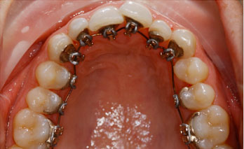 Foto von modernen Metall-Brackets, die nicht vorne, sondern hinten an den Zähnen angebracht werden.