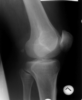 Röntgenaufnahme einer Knie-Arthrose